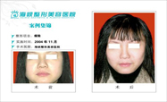 瘦脸对比图