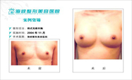 韩式无痕丰胸对比图