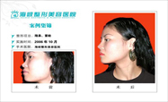 隆鼻 重脸对比图