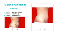 腰部 腹部前后对比图