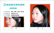 隆鼻对比图