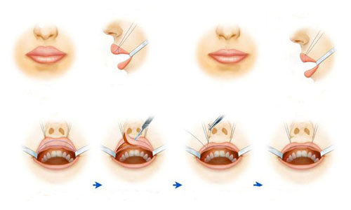 厚唇改薄_厚唇变薄费用_嘴唇太厚怎么办_改厚