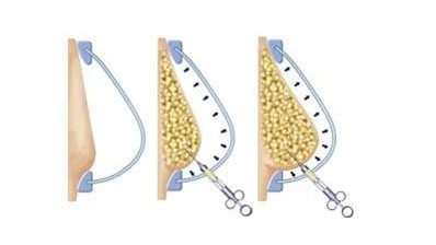 玻尿酸丰胸_丰胸价格_丰胸多少钱_厦门海峡整
